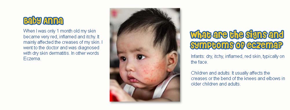 Eczema Time Line Part 1